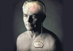 起搏器真的能治好帕金森病嗎？