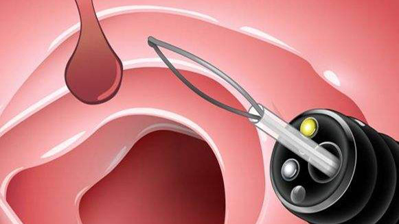 【健康解碼&middot;小貼士】檢查出息肉 需要切除嗎？