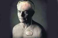 【健康解碼】起搏器真的能治好帕金森病嗎？